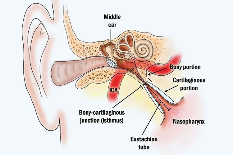 Eustachian tube dysfunction image